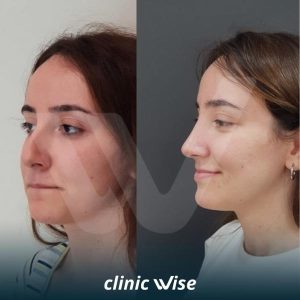 rhinoplasty-before-after-photos-in-turkey-2