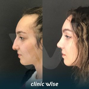 rhinoplasty-before-after-photos-in-turkey-5
