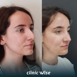 rhinoplasty-before-after-photos-in-turkey-6