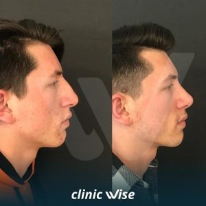 rhinoplasty-before-after-photos-in-turkey-7