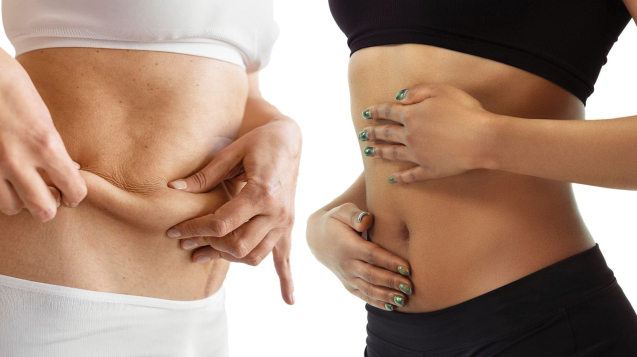 J Plasma assisted Tummy Tuck