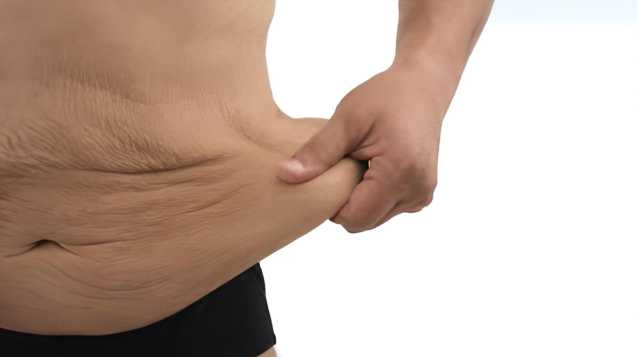 J-Plasma-assisted-Tummy-Tuck-Surgery