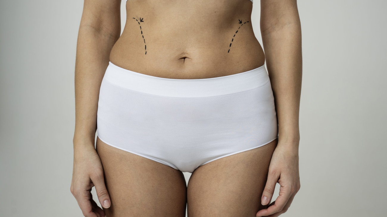 front-view-woman-with-marker-traces-abdomen