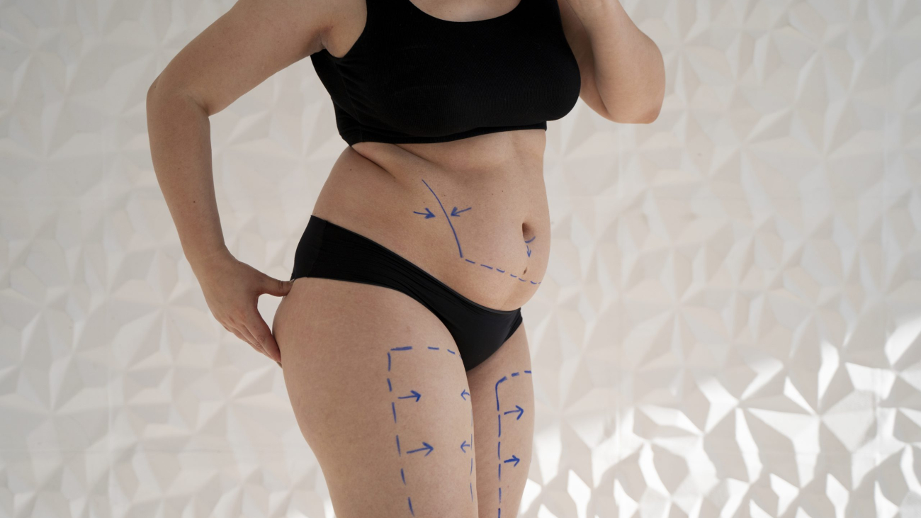 woman-s-body-with-marker-traces-side-view