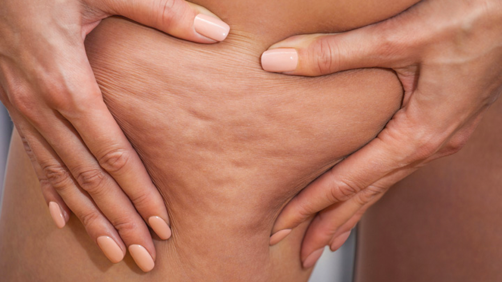 17694-cellulite-607252182